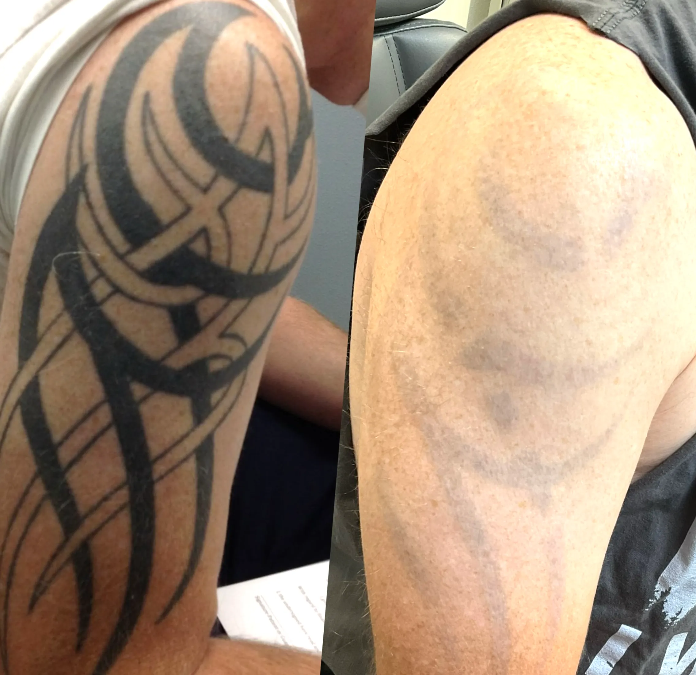 laser tattoo removal side effects