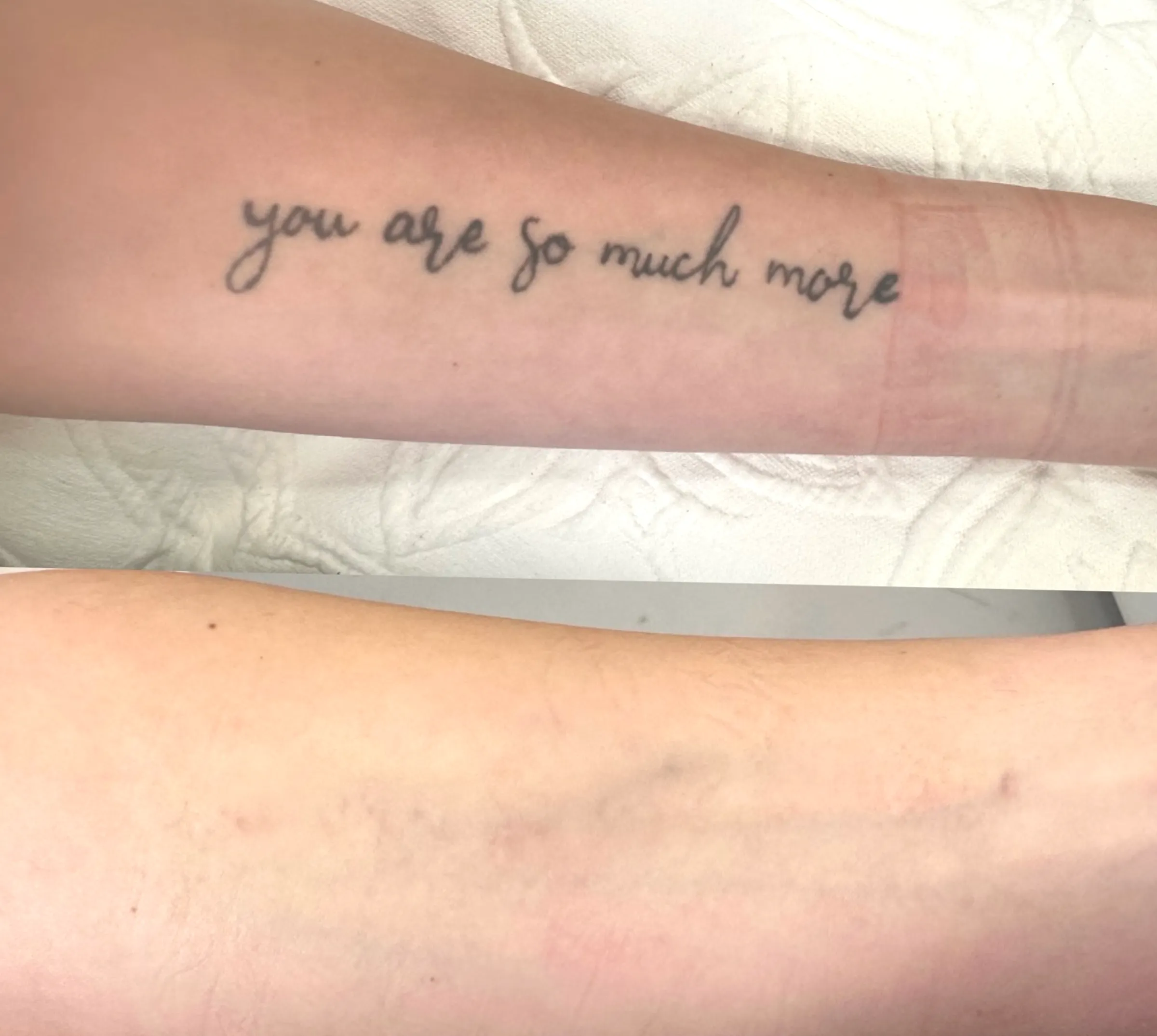 is laser tattoo removal safe