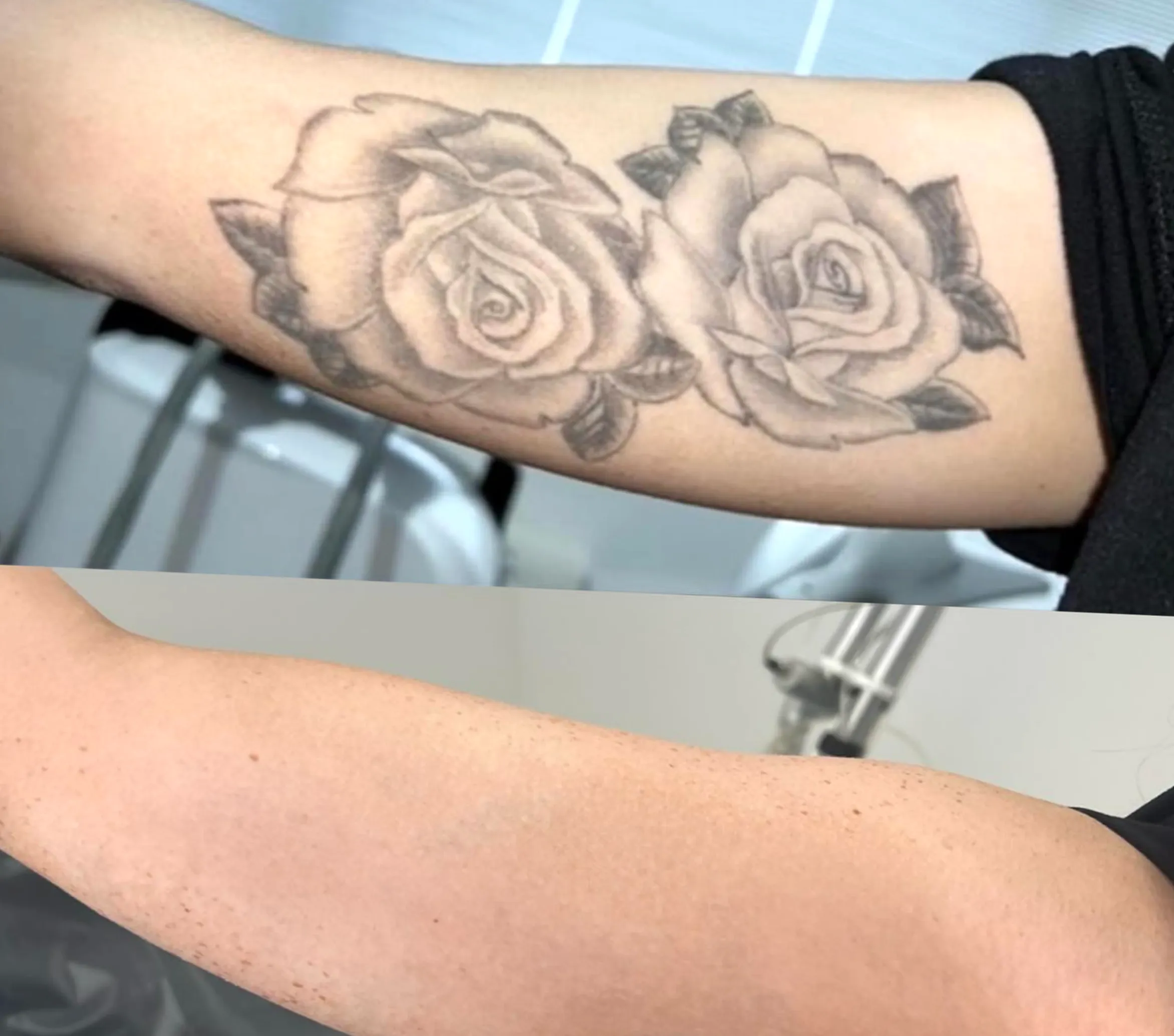 does laser tattoo removal cause cancer